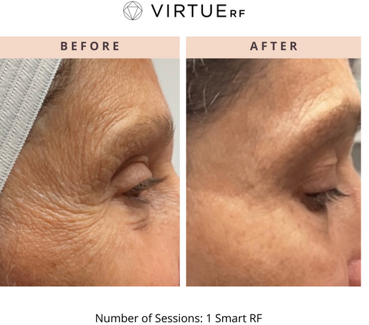 July RF Microneedling Special for Face and Decollete